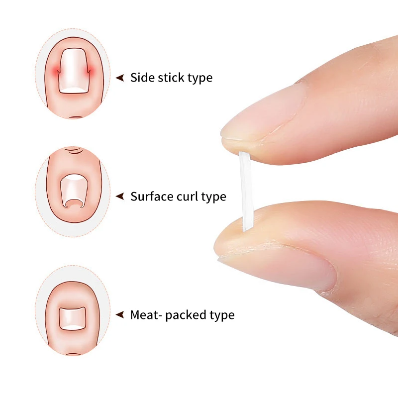 10/50pcs Ingrown Toenail Corrector Tools Ingrown Toe Nail Treatment Elastic Patch Sticker Straightening Clip Brace Pedicure Tool
