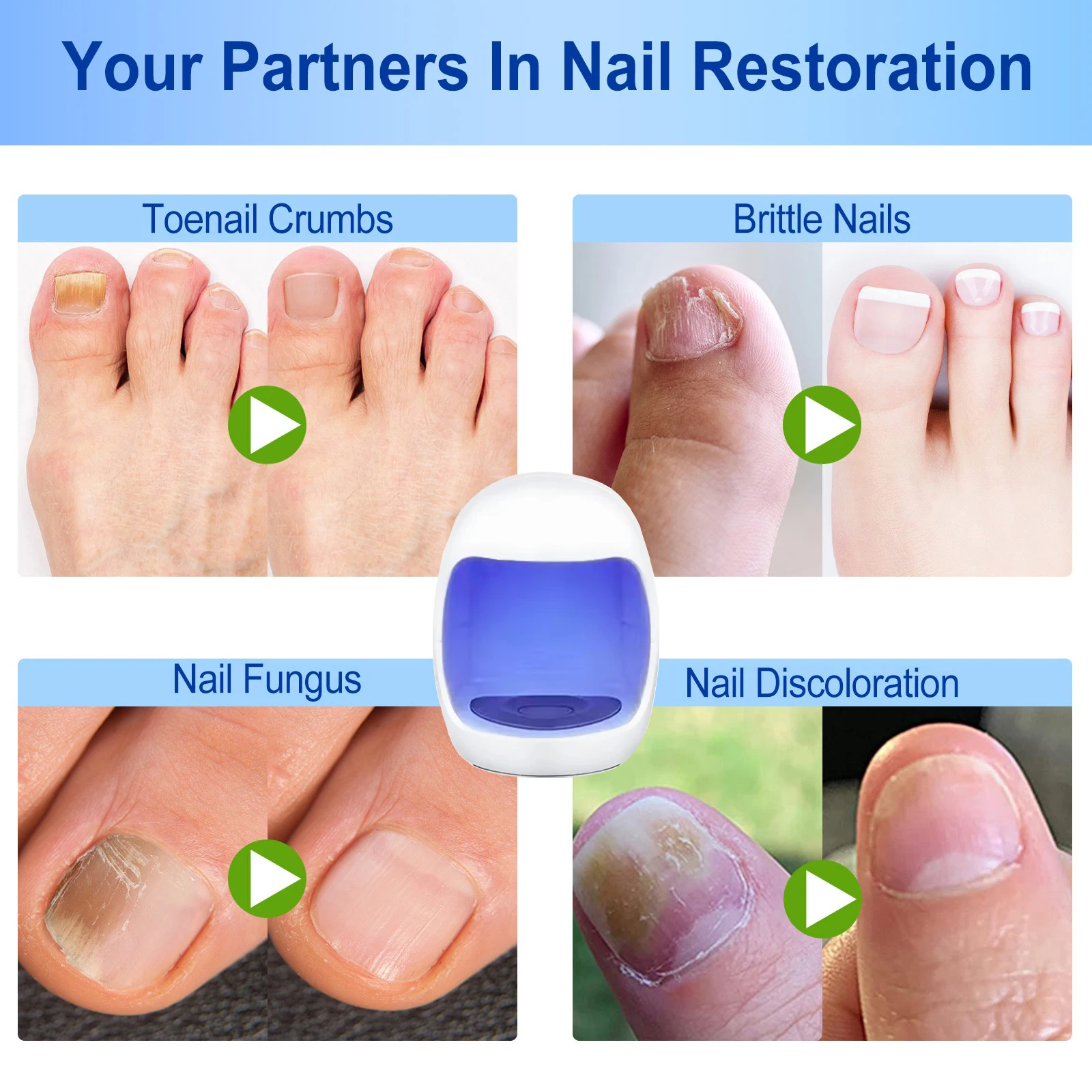 Fungal Nail Treatment Device Repair Fast Nails Fungus Onychomycosis Repair Toenail Fingernail Removes Nail Fungus Foot Care