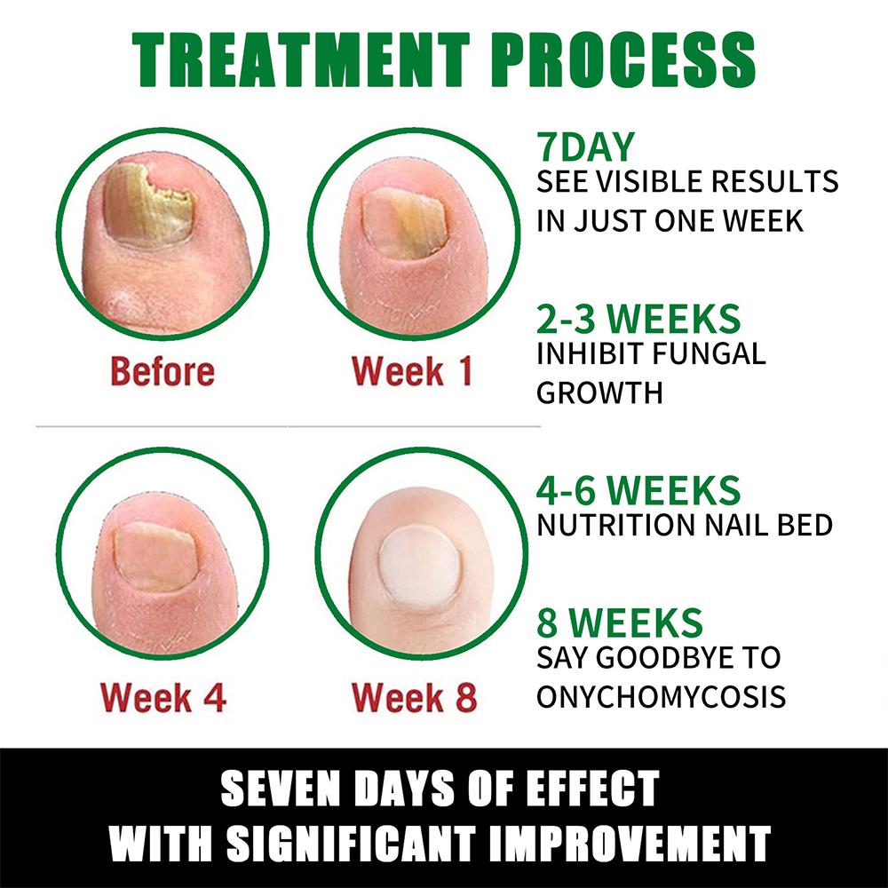 30ml Fungal Nail Treatment Essence Oil Nail Fungus Laser Device Repair Toenail Fingernail Treatment Onychomycosis with Mushrooms