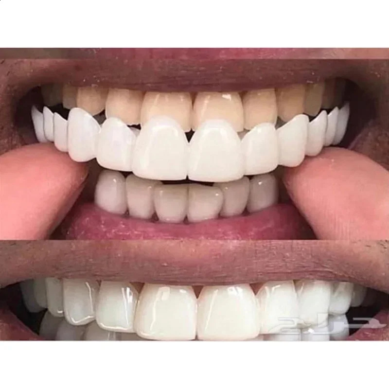 Top Quality Upper Plus Lower Comfort Fit Flex Whitening Tooth Denture Braces 241105