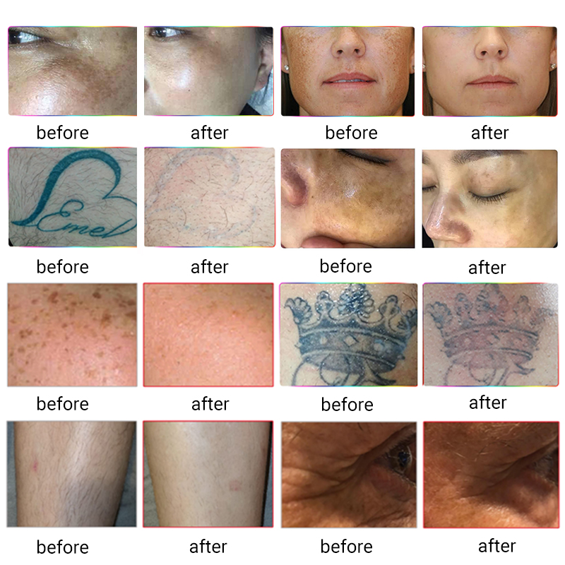 Wholesale Multifunction laser depilatory 4 in 1 elight ipl opt rf nd Yag Tattoo removal hair removal beauty machine
