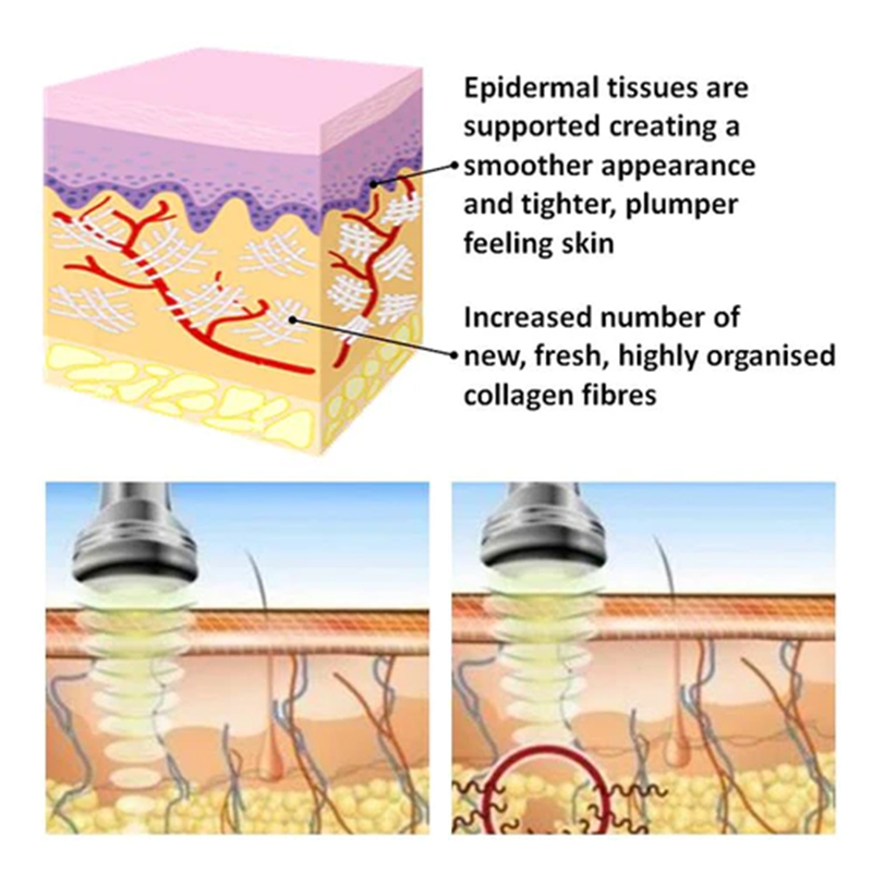 6 In 1 Slimming Machine Vacuum Laser Radio Frequency Rf 40k Body Cavitation Lipo Liposuction Ultrasonic skin whitening device Firming System