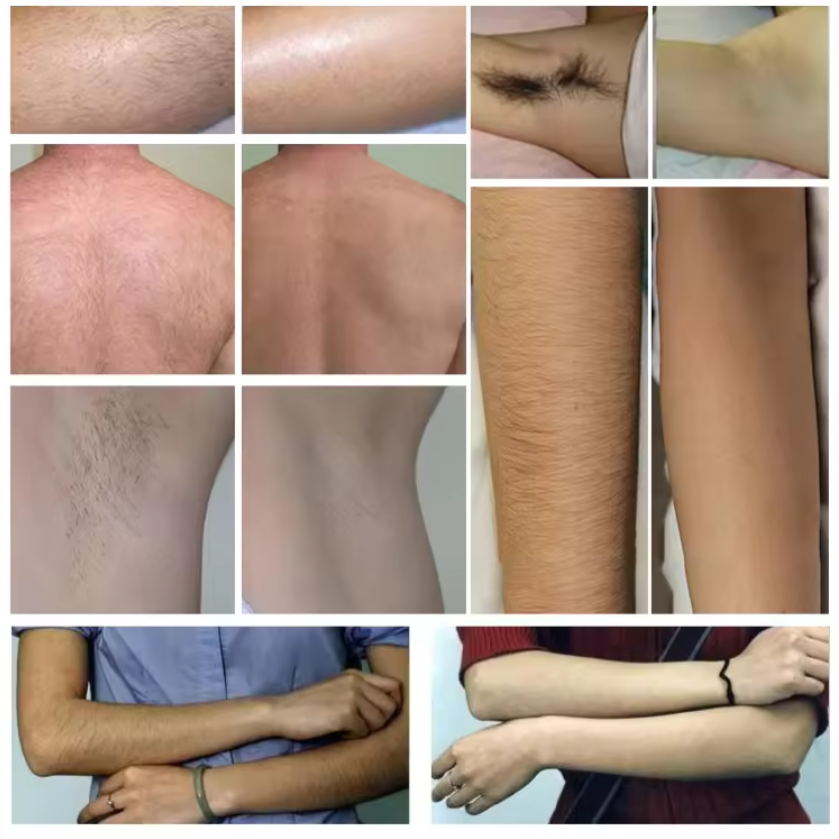 Portable permanent hair removal 808 diode laser hair removal machine