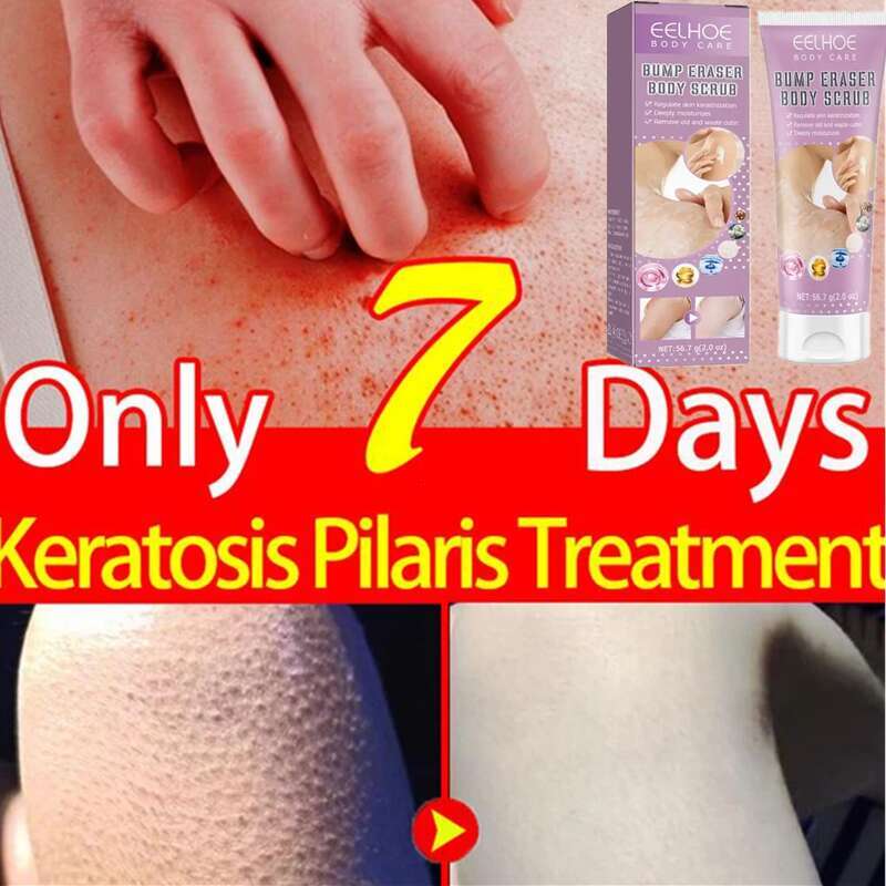 Moisturizing Scrub Keratin Hyperplasia Removing Strawberry Legs Repairing Nourishing Body Skincare Products