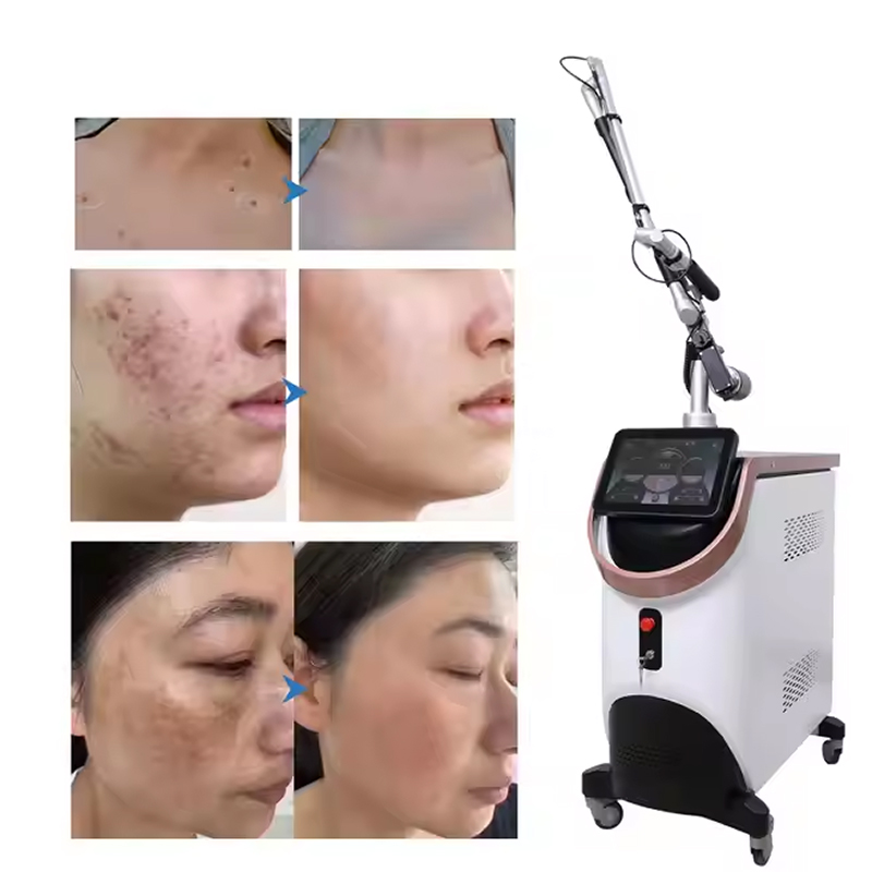1064/532 laser nd yag picosecond pigmentation correction q switch tattoo removal machine for freckles remove