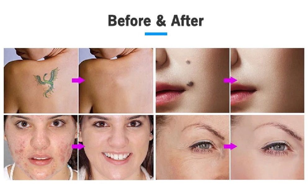 2 in 1 Cold Plasma Shower Skin Tightening Wrinkle Removal Eyelid Lifting Plasma Face Lift Fibroblast Plasma Pen