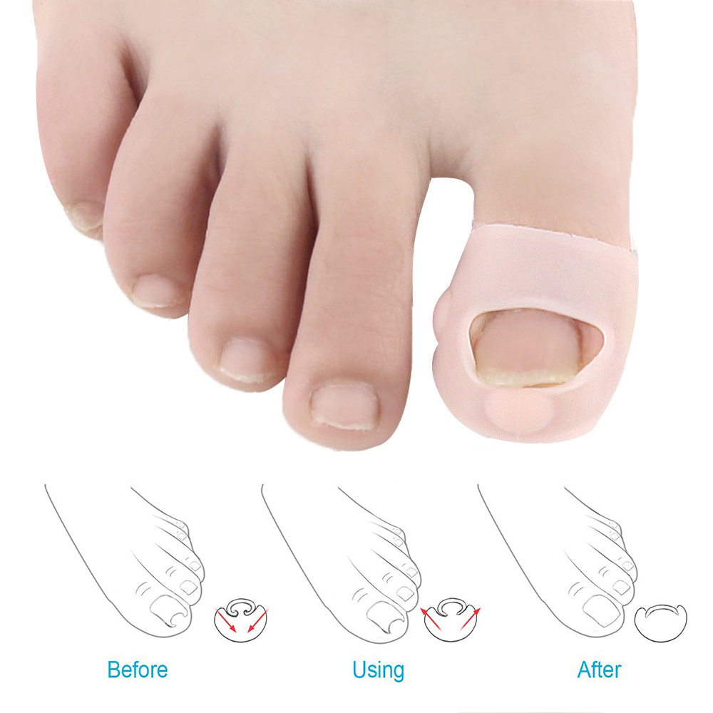Pexmen 2/4/10Pcs Gel Ingrown Toenail Corrector Sleeves Big Toe Nail Healing Care Protectors Paronychia Treatment Pedicure Tool