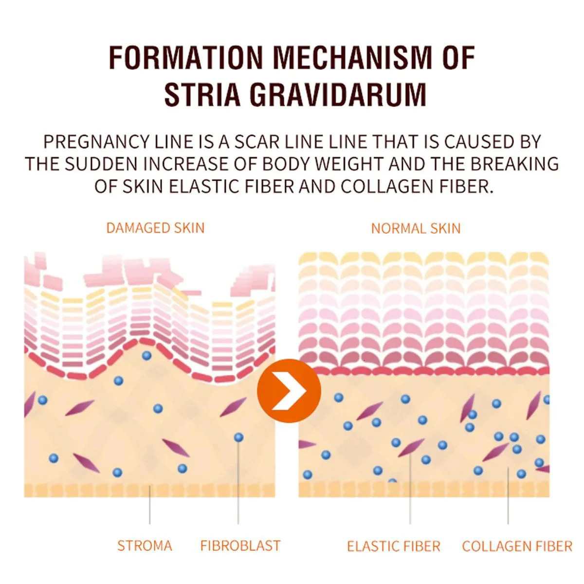 Pregnant Woman Stretch Mark Repair Cream Postpartum and Fade Marks To Prevent Obesity Moisturizing Skin Care 241112