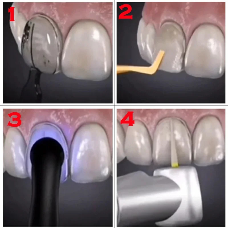 Dental mold for composite dental resin veneer popolymerization filling front teeth whitening dental laboratory dental tools 241113