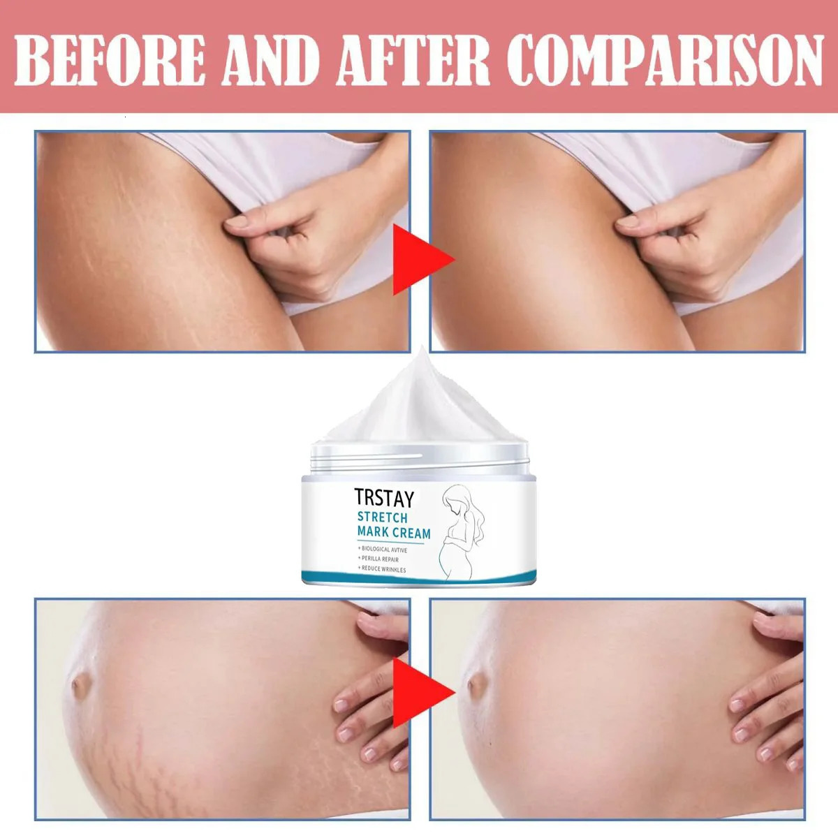 Pregnant Woman Stretch Mark Repair Cream Postpartum and Fade Marks To Prevent Obesity Moisturizing Skin Care 241112