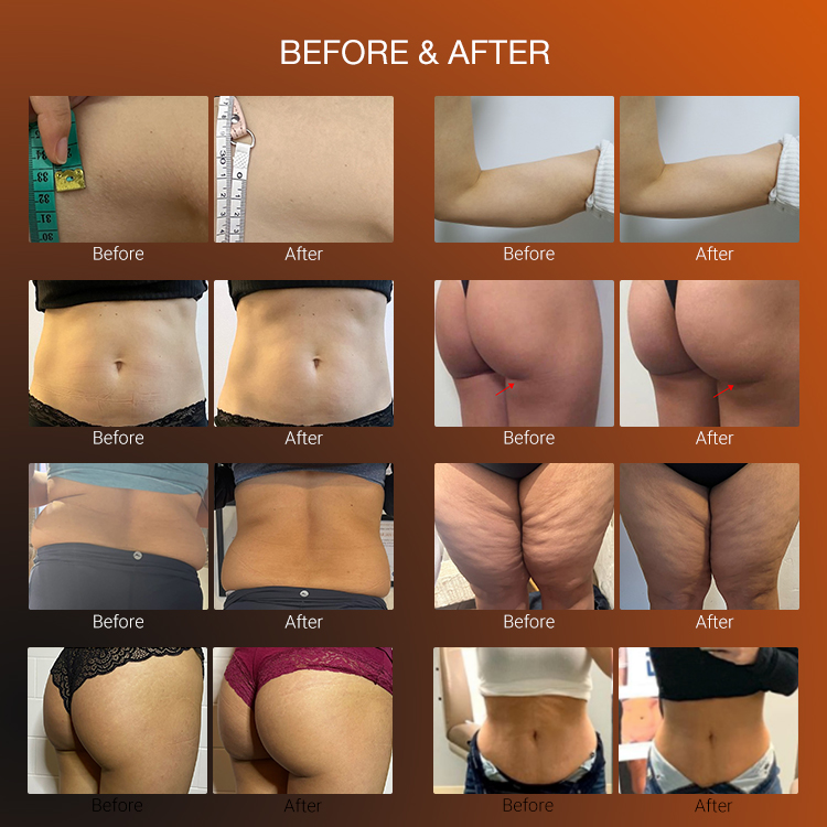 Ems Weight Loss Body Sculpting 4 Handle Emslim Neo Rf Muscle Stimulator Ems Body Sculpt Machine