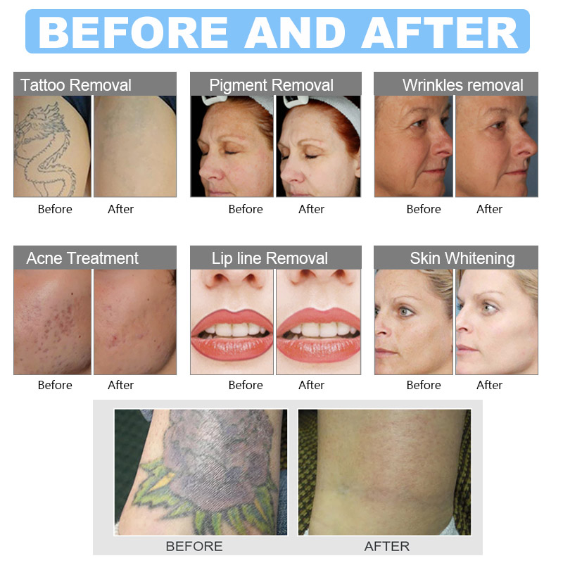 Portable Picolaser Nd Yag Pico Second Picosecond Laser Remove Freckles Q Switched Laser For Tatoo Removal Black Doll Treatment Skin Rejuvenation Machi