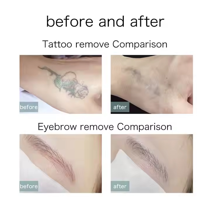 532/1064nm no scars q switch laser therapy tattoo removal nd yag spots acne treatment picosecond machine