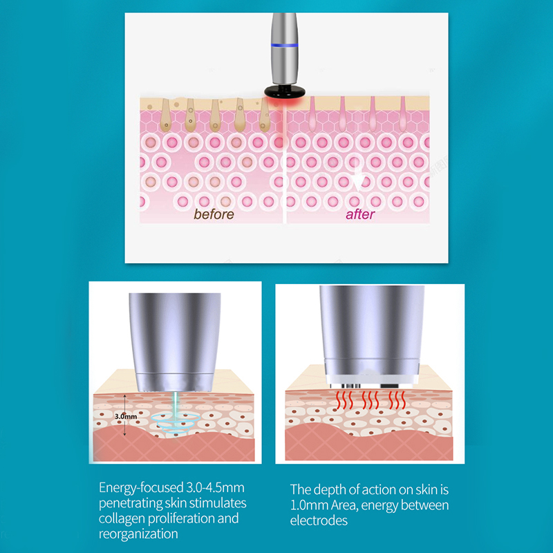 Layered anti aging beauty microcurrent skin lifting radiofrequency heating No-cartridge Vmax instrument