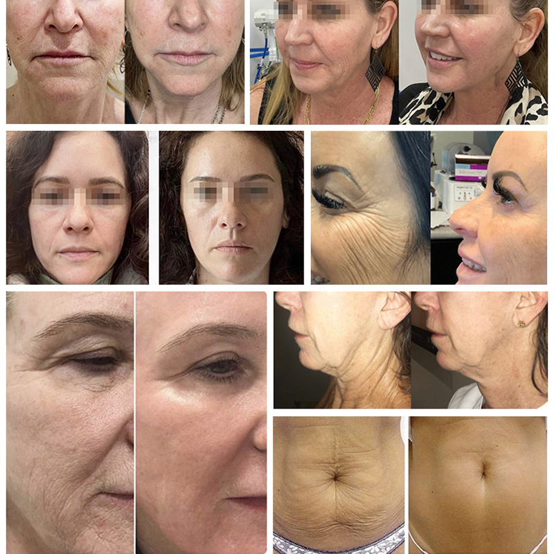 Radio frequency facial beauty micro needle machine portable rf anti aging fractional microneedle scar treatment device 2 handle