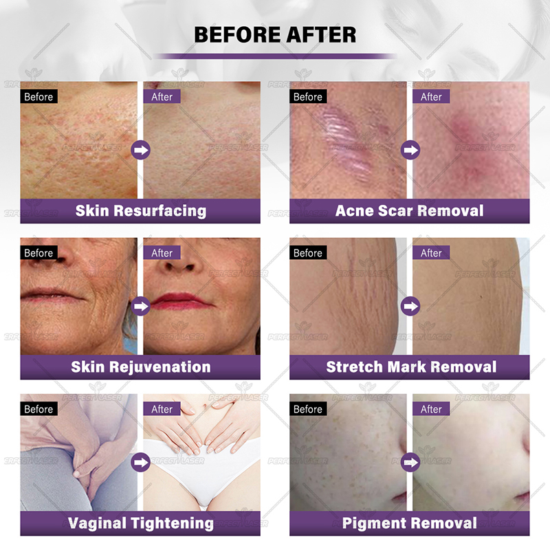 Laser CO2 Aesthetics Pigment Removal Device for Acne Scars removal Machine