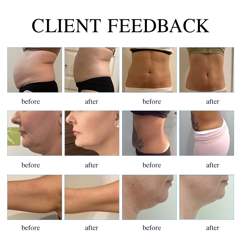 Newest 40K Ultrasonic Cavitation Machine RF Vacuum body Slimming Bipolar Skin Care cellulite machine