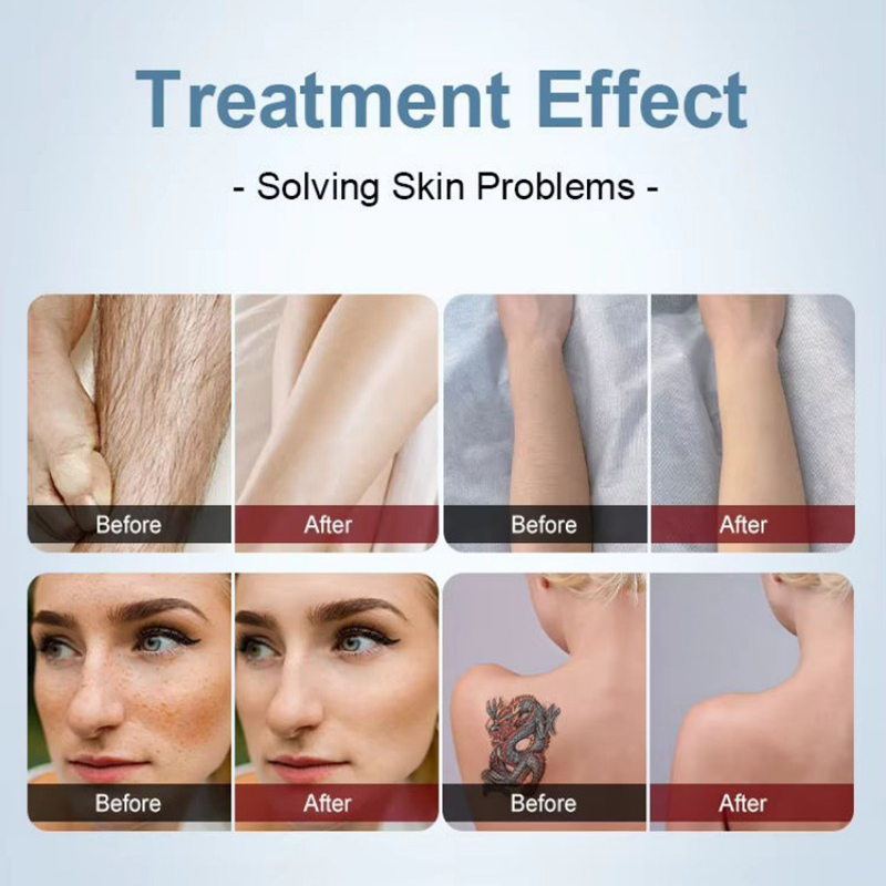 Non-invasive tattoo removal picosecond Diode hair laser removal Nd Yag Photon Skin Rejuvenation Machine