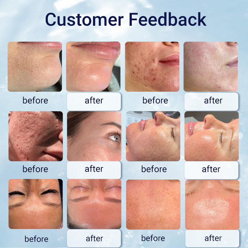 15 in 1 hydrodermabrasion diamond microdermabrasion machine facial skin peeling hydra facial beauty equipment