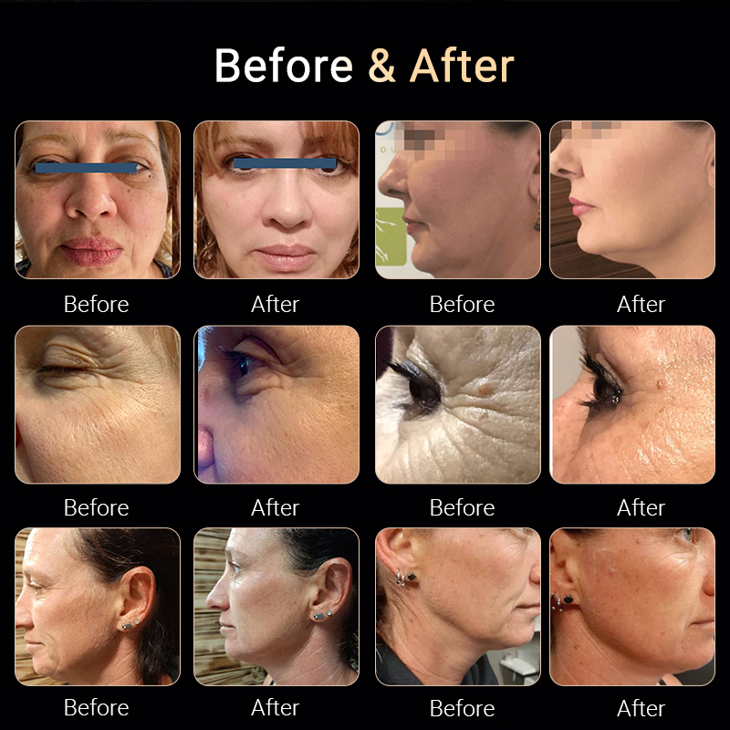 Newest 3D 12D HIFU Machine High Intensity Focused Ultrasound for HIFU Face Lifting Skin Tightening Body Slimming 3 Handles