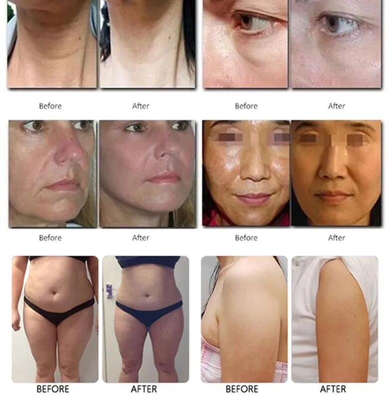 2024 Effective 7D/9D Facial Treatment Anti-Wrinkle Ultra Ultrasonic body slimming skin tightening wrinkles removal skin lift Skin Rejuvenation Beauty 