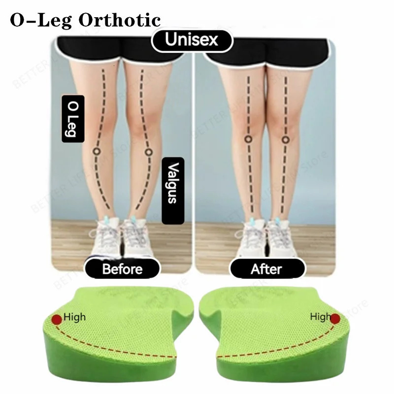 PU straightening arch support pad O/XO leg shoe sole pad used for foot valves Varus straightening pads pain relief inserts 240612