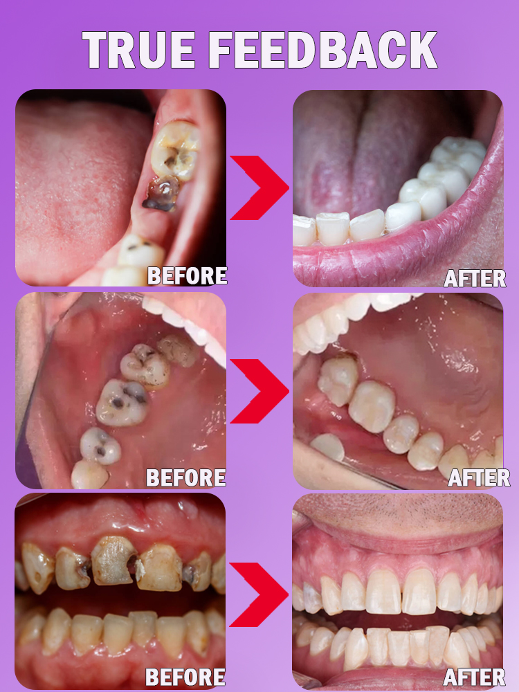 Repair Tooth Decay All Cavities
