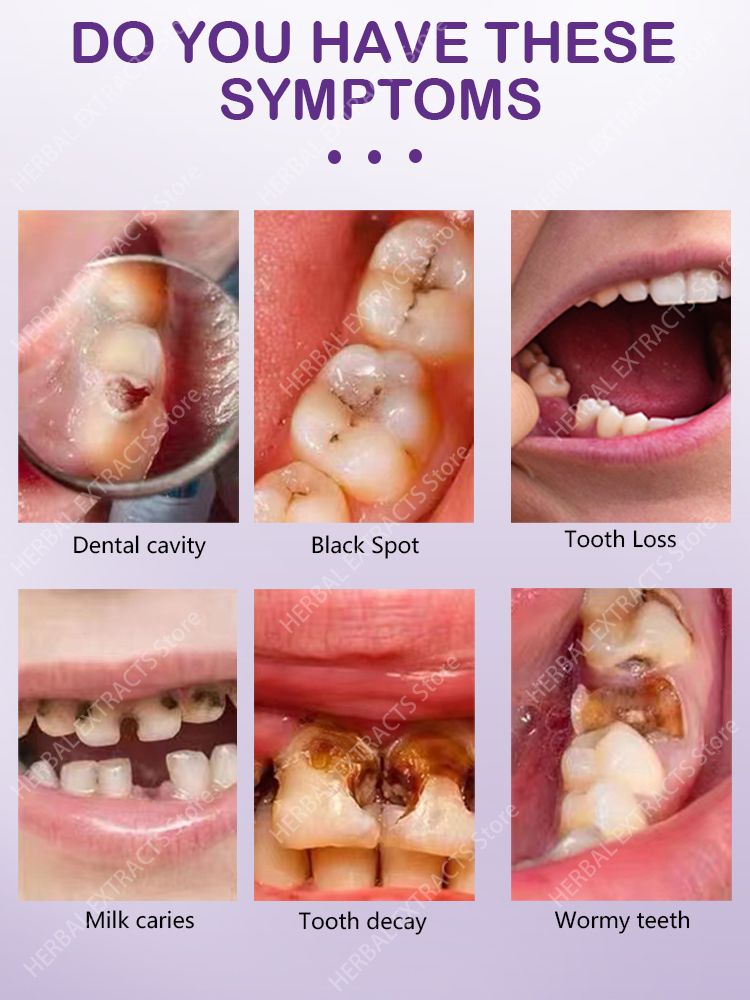 Repair Tooth Decay All Cavities