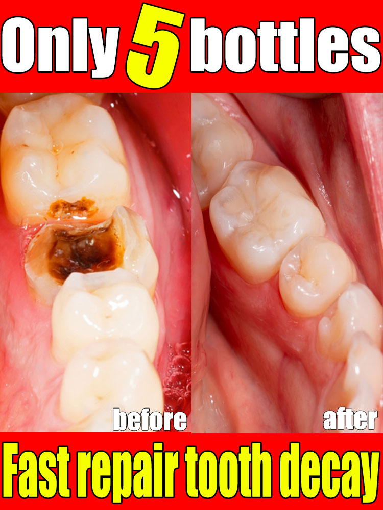 Repair Tooth Decay All Cavities