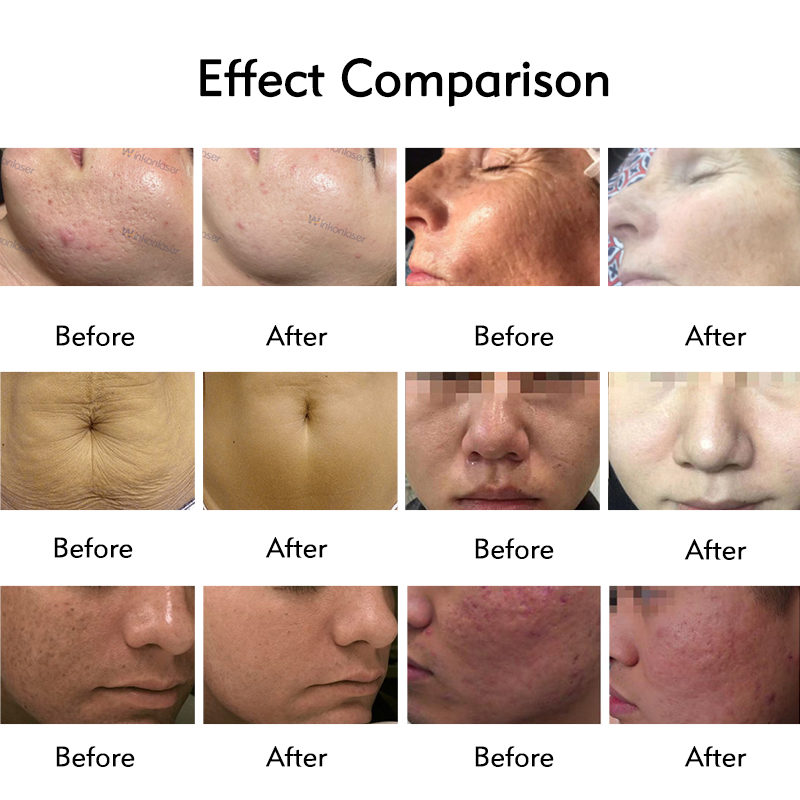 Fractional Wrinkle Remover anti-aging Equipment RF Skin Tighten Microneedling Acne Scar Removal Shrink Pores Machine Salon Home Use