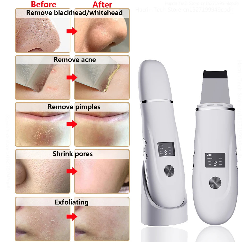 Ultrasonic Peeling r Blackhead Skin Scrubber Shovel Deep Cleaning Face Removal Pore Acne EMS Lift 240626