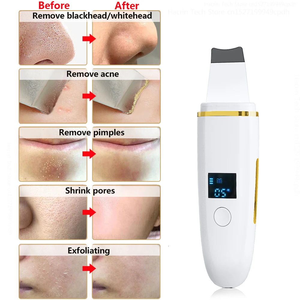 Ultrasonic Skin Scrubber Ultrasonic Peeling Scrubber Shovel Deep Cleaning Face Pore 240626