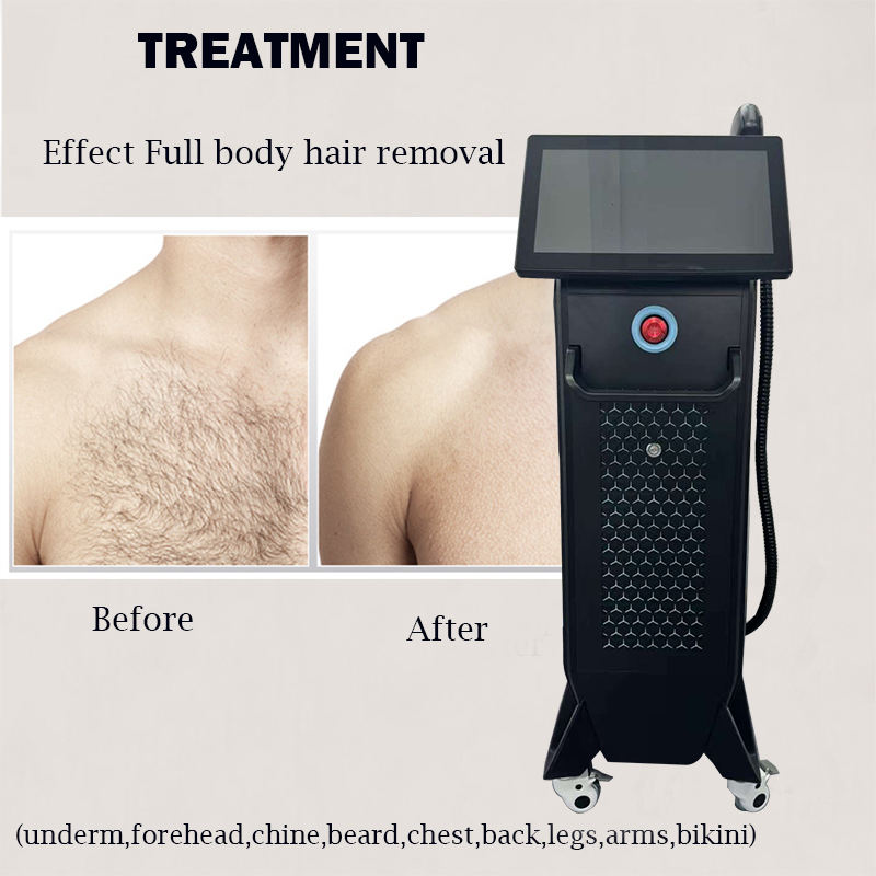 3 Wavelength Non-invasive Diode Laser Hair Removal Painless Freezing Point Depilation Hair Root Damage 755nm 808nm 1064nm Skin Smoothing Machine