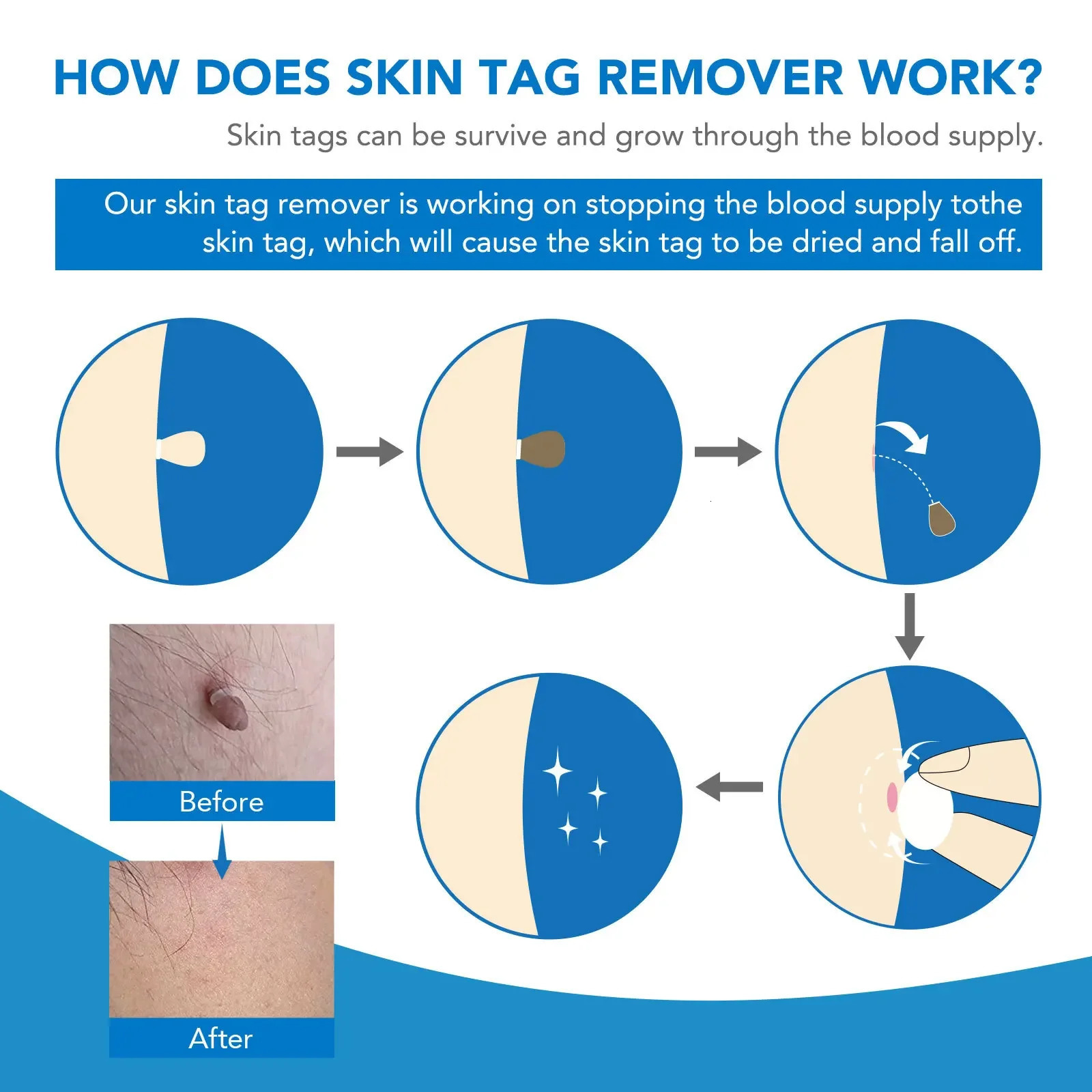 Skin Tag Removal Kit Home Mole Wart Puntos Negros r Equipment Micro Skin Tag al Tool Easy To Clean Skin Care Tool 240629