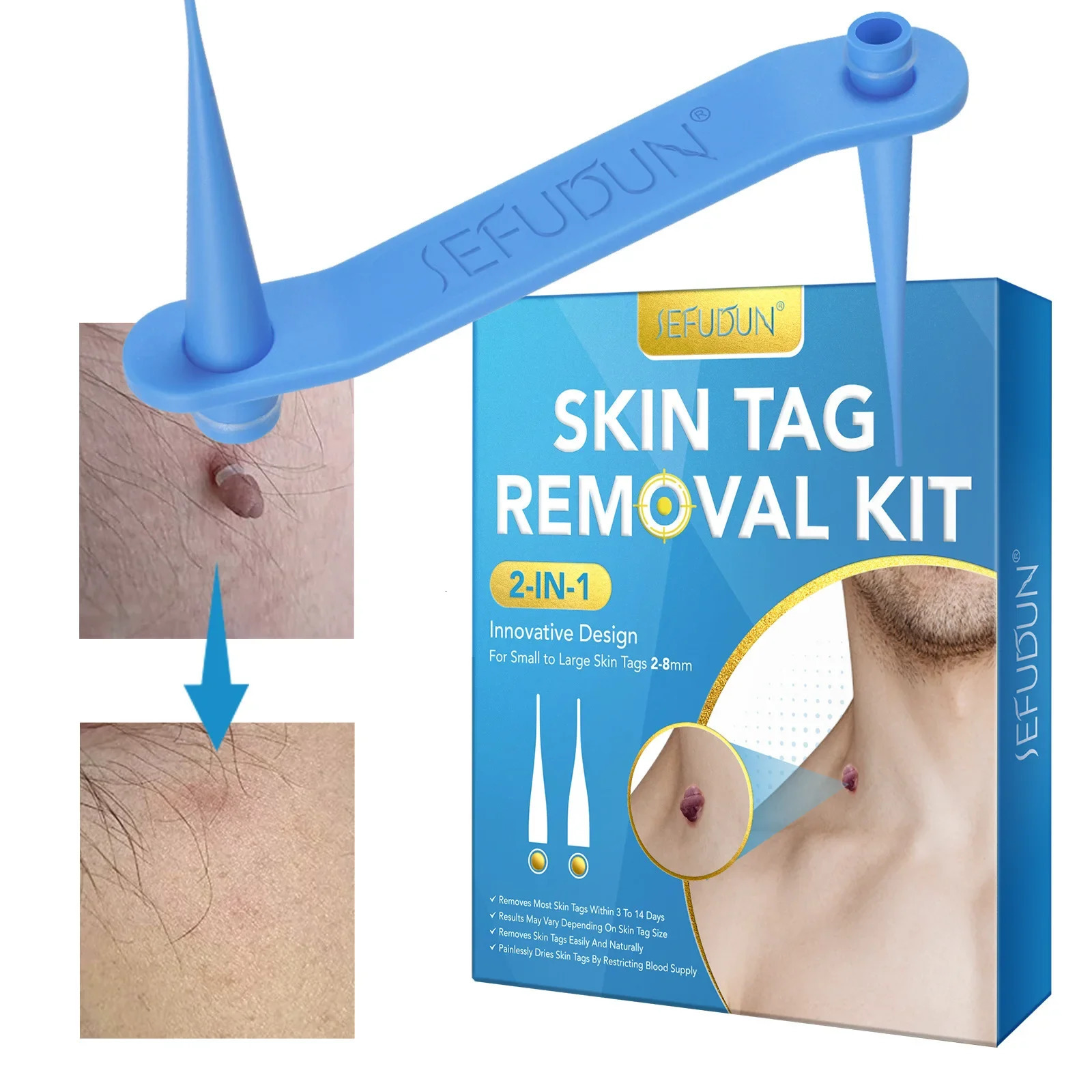Skin Tag Removal Kit Home Mole Wart Puntos Negros r Equipment Micro Skin Tag al Tool Easy To Clean Skin Care Tool 240629