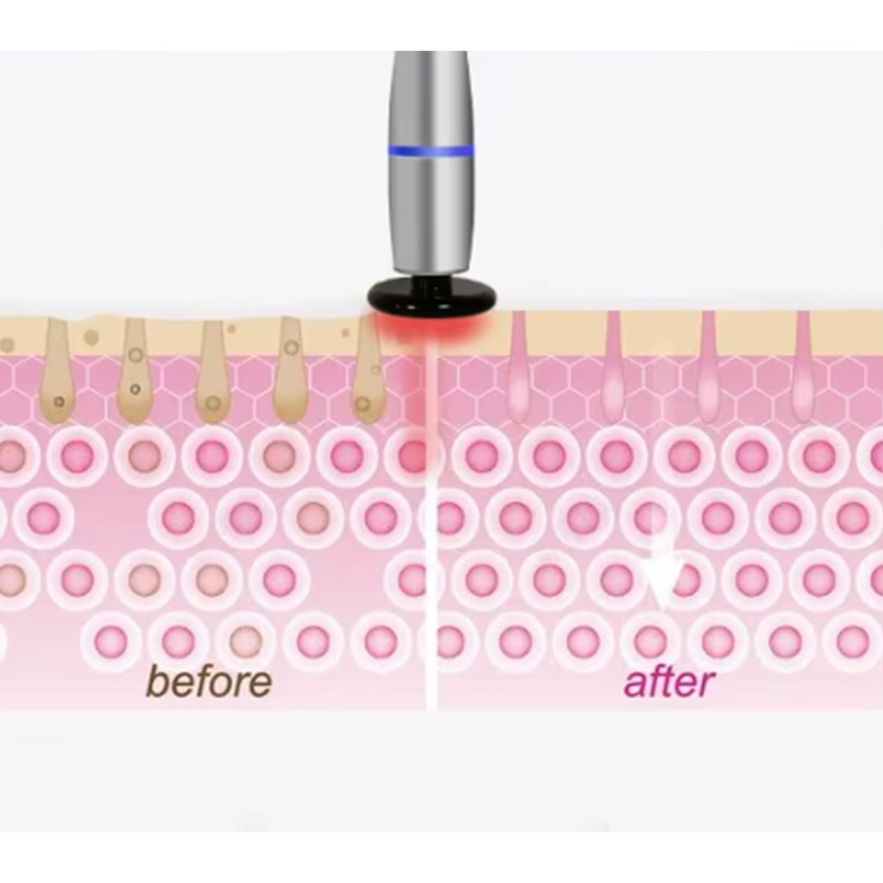 Powerful Ultrasonic Skincare And Radiofrequency Thermal Therapy Layered Anti Aging Beauty Device Skin Tightening, Skin Rejuvenation