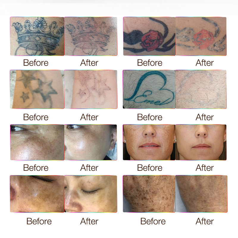 Picolaser Machine Freckle Tattoo Removal Korea Imported Laser Arm 532nm 1064nm Pico Nd Yag Laser pigments acne removal Machine