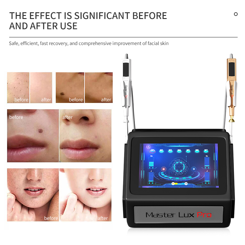 Professional 2 In 1 Plasma Beauty Machine Flash Plasma+ozone Plasma Facial Lifting And Firming Removing Spots And Wrinkles Anti-aging