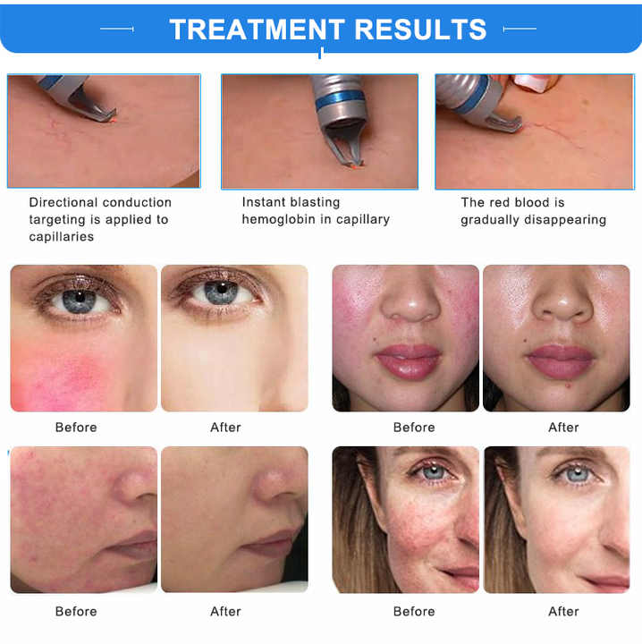 980nm Diode Laser Vascular&Spider Veins Red Blood Vessels Removal Treatment Remover Machine