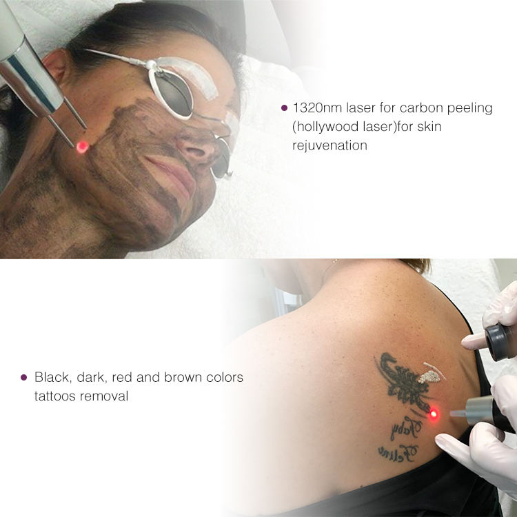 Professional tattoo removal freckle removal 785nm 1064nm 532nm Q-switched nd yag picosecond laser machine Eyebrow Removal