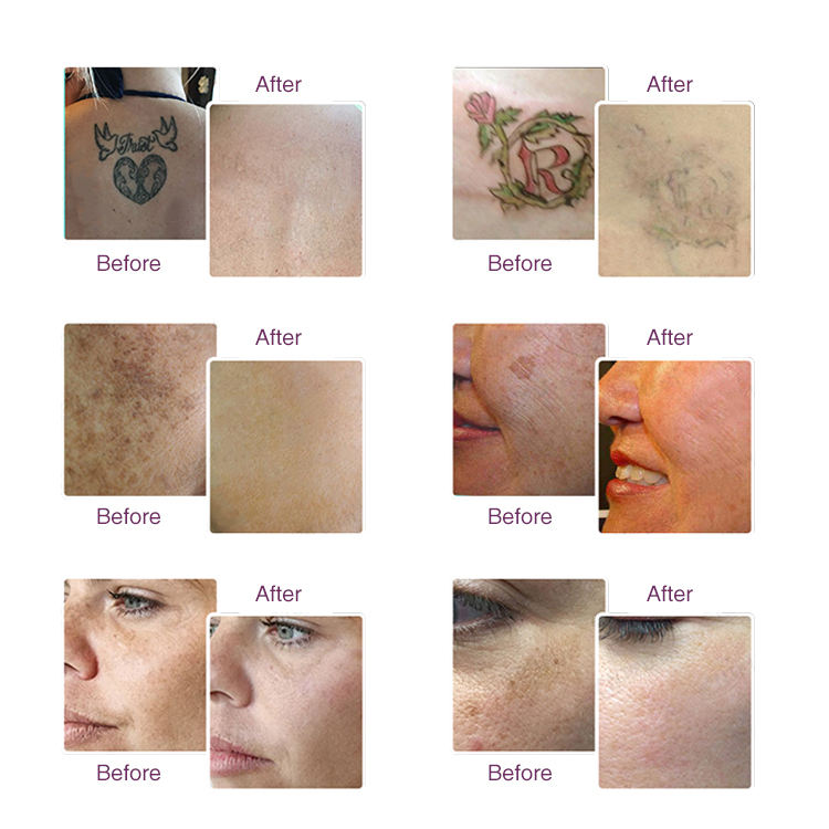 Professional tattoo removal freckle removal 785nm 1064nm 532nm Q-switched nd yag picosecond laser machine Eyebrow Removal