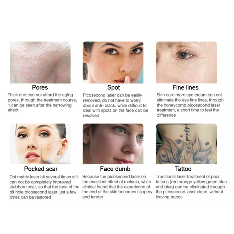 Best Selling Products Pico Laser 755nm Tattoo Pigment Removal Q Switched Nd Yag Laser Tattoo Removal Picosecond Laser Tattoo Eliminate Machine