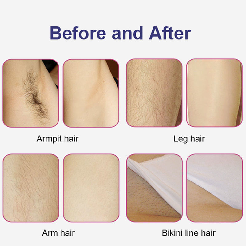 Super Nd Yag Laser Tattoo Removal Opt Hair Removal Machine Laser Permanent Hair Removal Beauty Machine Acne Treatment Skin Rejuvenation