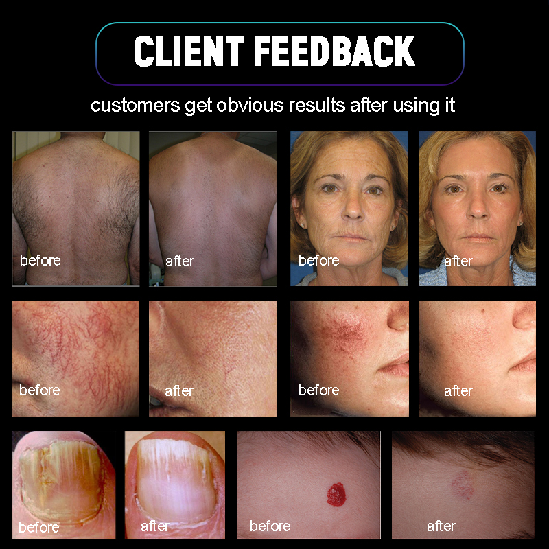 2024 Professional Long Pulse Nd Yag 1064nm Laser Machine Alexandrite 755nm Laser Hair Removal Acne Treatment Vascular Legions Remove Epilator Hair Rem