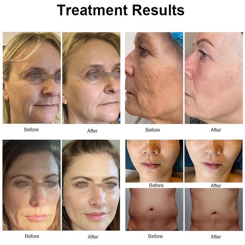 2023 Portable RF Beauty Face Lift 7d Hifu Anti Wrinkle Skin Tightening Ultramage 7d Hi-fu Machine