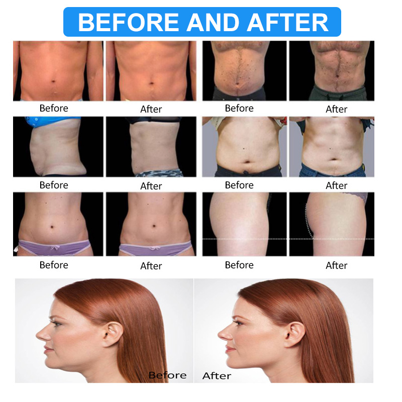 360 Degree Cryolipolysis Cryo Body Slimmer Machine Cellulite Reduction Fat Freezing Cryolipolysis 4 Handles Vacuum Weight Loss Body Shaping Device Hom