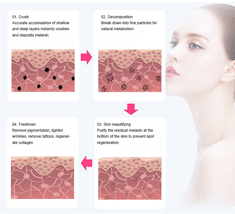Professional Laser Tattoo Removal 755nm 1064nm Machine Picosecond Laser Cosmetic Laser Equipment