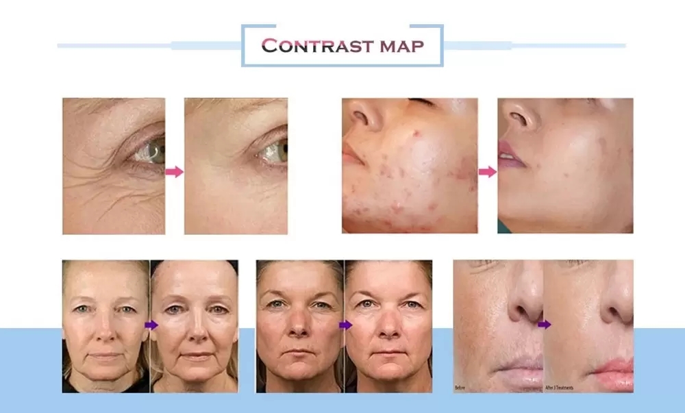 Professional Microneedle Rf wrinkle removal / Best Rf Skin Tightening Face Lifting Machine / Fractional Rf Micro Needle