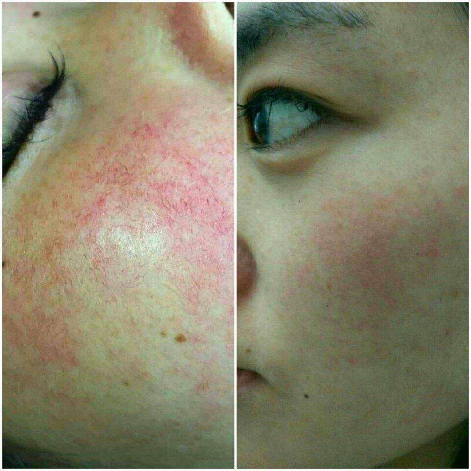 980nm Diode Laser Machine Vascular Removal Nails Fungus Treatment Skin Rejuvenation