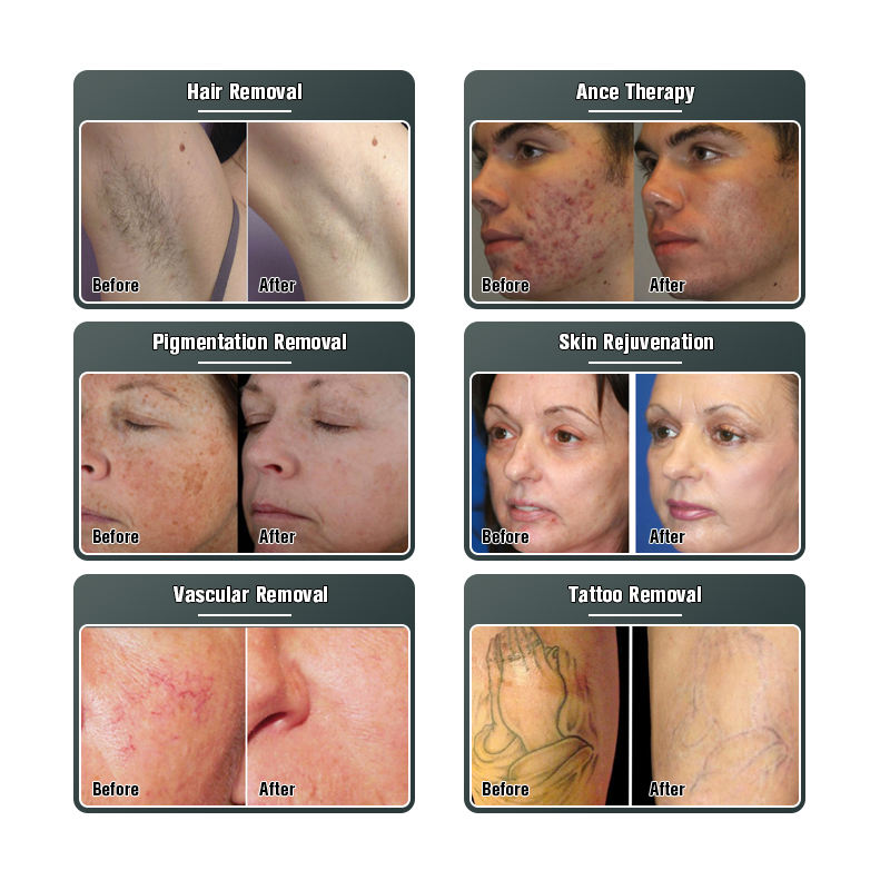 3 IN 1 nd yag laser/laser tattoo removal machine price with IPL OPT Hair Removal RF Skin Rejuvenation Face Lift System